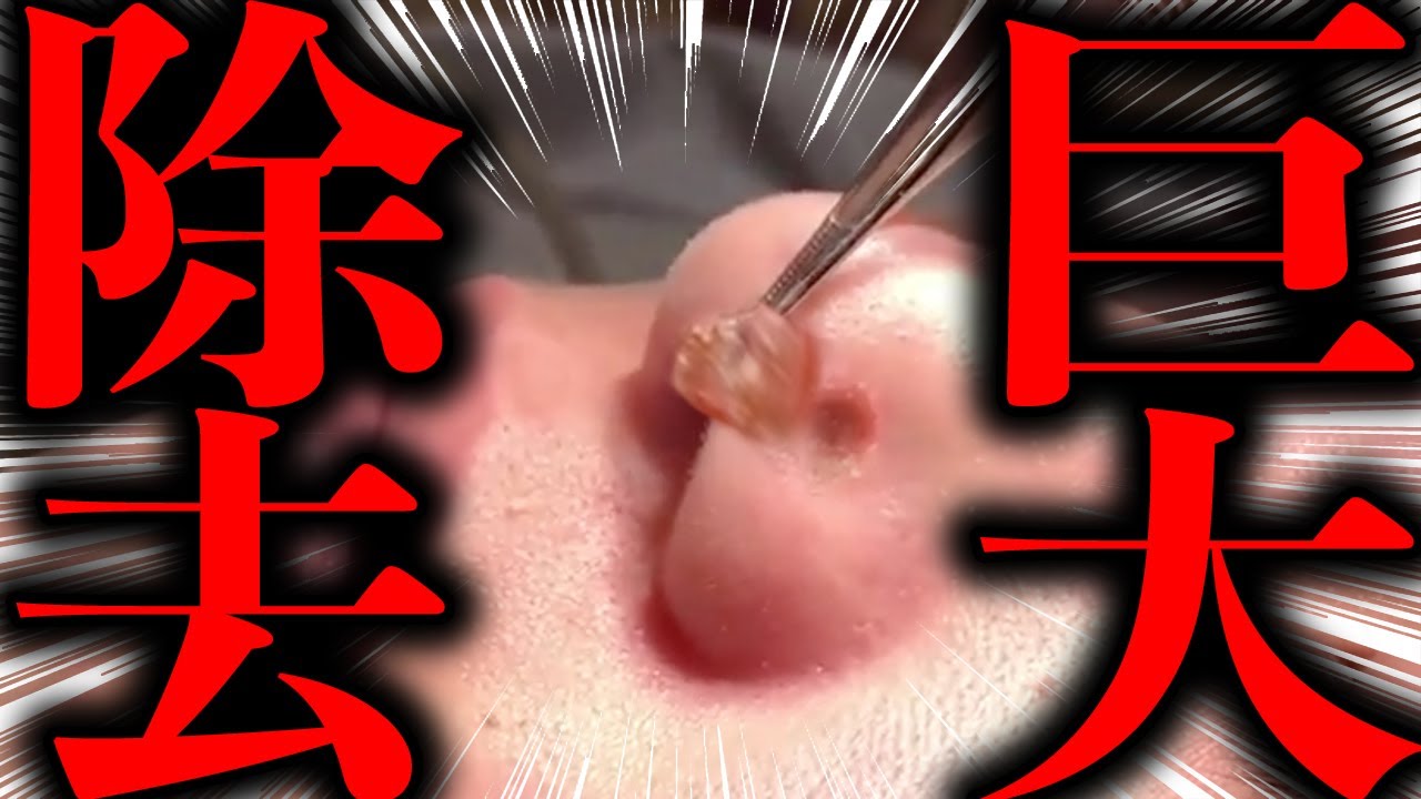 大公開 巨大ほくろをブっこ抜く この神業に注目 Youtube