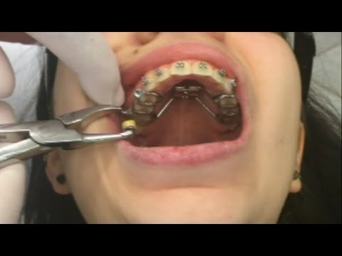 Presenting the Herbst appliance (Part 4) | Tom Nasiopoulos Orthodontist Thessaloniki