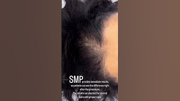 Transform Your Look with Scalp Micropigmentation (SMP) at EDEN AESTHETICS Dubai | Immediate Results!