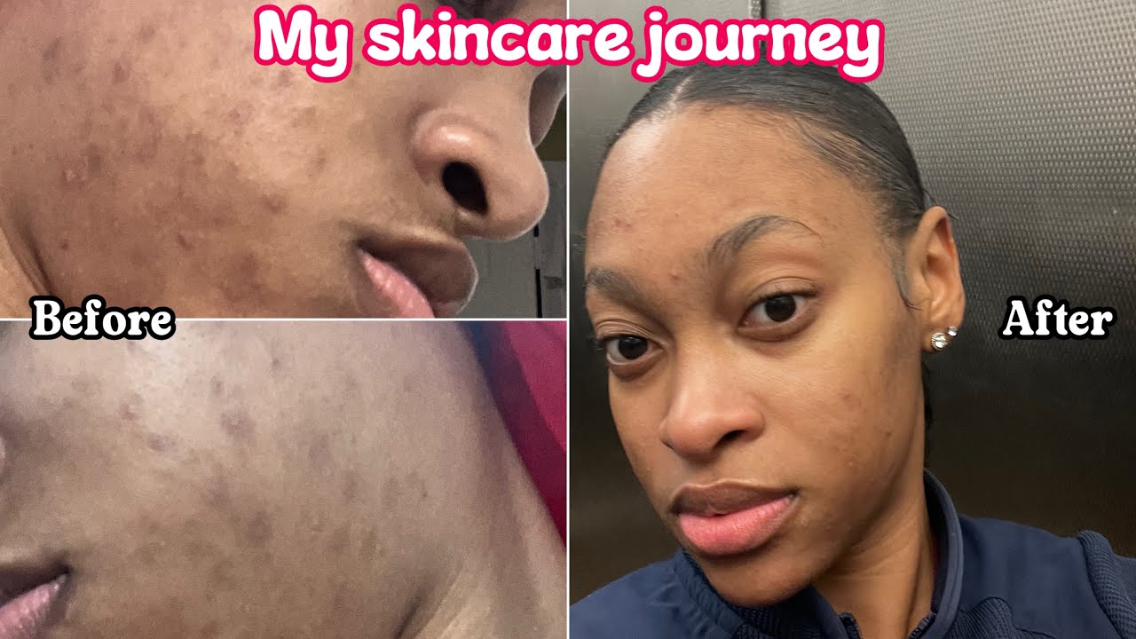 HOW I CLEARED MY HORMONAL ACNE & DARK SPOTS + MY SKINCARE PRODUCTS ...
