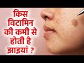 झाइयां किस विटामिन की कमी से होती है | Jhaiya Kis Vitamin Ki Kami Se Hoti Hai | Boldsky
