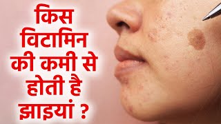 झइय कस वटमन क कम स हत ह Jhaiya Kis Vitamin Ki Kami Se Hoti Hai Boldsky