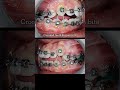 Braces to correct misalignment and open bite. #braces #dentist #orthodontist #teeth