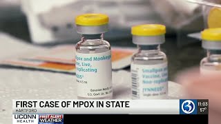 First case of mpox detected in Connecticut