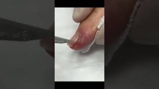 Finger Nail Removal