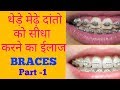 ब्रेसेस के प्रकार एवं खर्च |Types and Cost of Braces in Hindi | part -1