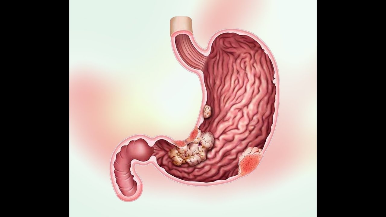 Аденокарцинома желудка — распространенный тип рака желудка, возникающий из железистых клеток.