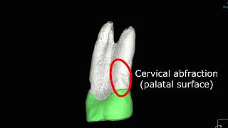 Learn From Failure Maxillary First Premolar, Cemental Tear, Apical Delta, Inaccessible C