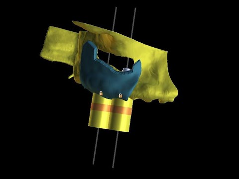 Planning Lateral Sinus Guide Video