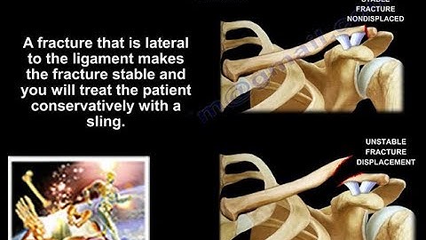 Distal Third Clavicle Fracture - Everything You Need To Know - Dr. Nabil Ebraheim