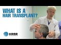 What is a hair transplant  hair restoration blackrock