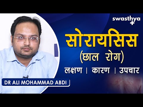 सोरायसिस (छाल रोग) – कारण, लक्षण, उपचार | Dr Ali Mohammad Abdi on Psoriasis in Hindi | Treatment