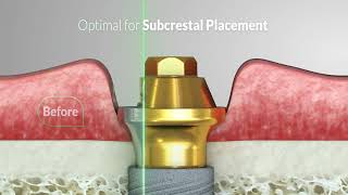 Classic vs. Innovative Alpha™ Arch Design