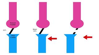 Pivot Shift Test