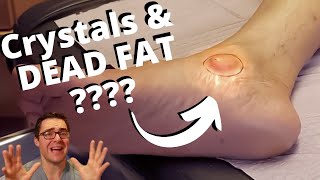 HUGE Foot PIMPLE filled with dead FAT & Crystals????