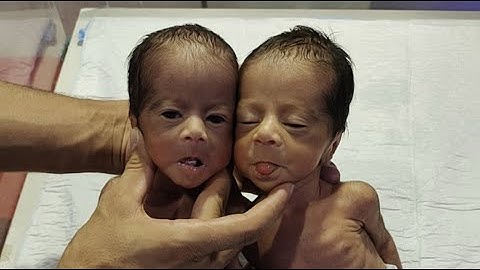 👶👶 Twin Premature Babies Live in NICU | So Cute & Heart-Touching Moments 💕