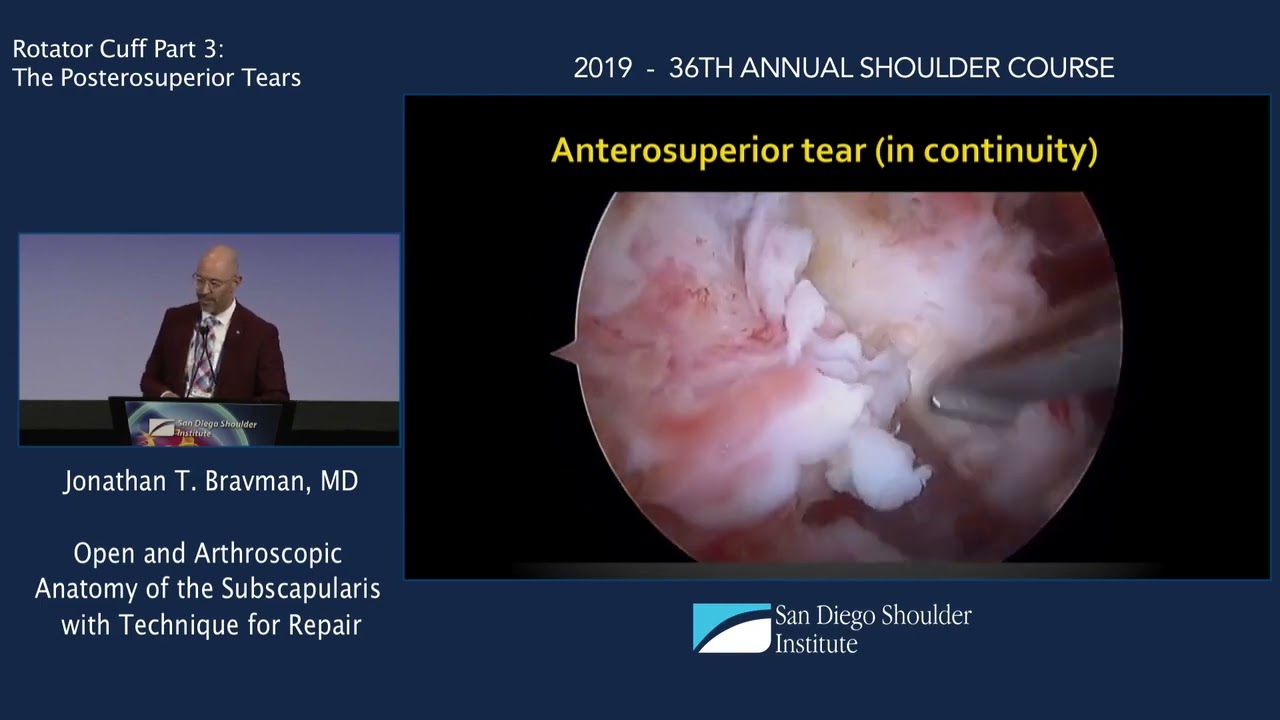 Open and Arthroscopic Anatomy of the Subscapularis with Techniques for Repair