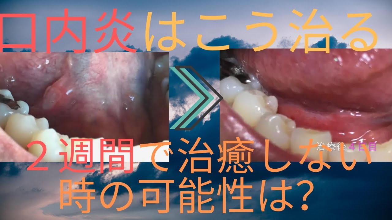 口内炎はこう治る!口内炎治療と治癒経過を写真で見せます - YouTube