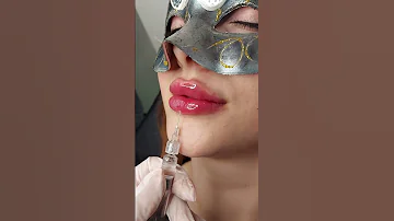فيلر تجميل شفايف بوتوكس جمال 