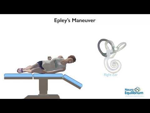 Epley’s Maneuver: A Step by Step Guide to Treat BPPV Vertigo