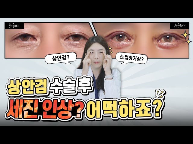 [눈수술]상안검 후 세진 인상😠 수술 방법에 문제가 있을 수 있습니다