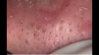 #12 Blackhead Removal \ Удаление черных точек