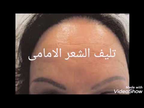 تليف الشعر الامامى 😰 فنانة مشهورة أصيبت به قبل وفاتها ولم تشخص 😔 frontal fibrosing alopecia