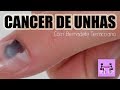 CANCER DE UNHAS: O QUE VOCÊ PRECISA SABER