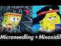 Microneedling with minoxidil