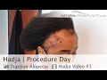 Black Woman Receding Hairline Transplant Procedure Day | Dr Harold Siegel (Hadja)