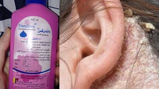 جاوبت على أسئلة متكررة عن شامبو إزالة القشرة و الفطريات / شامبو كيتوكونازول / شامبو فافو 💇