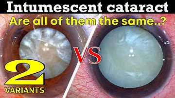 Intumescent Cataracts .Are all of them the same..?  - Dr Deepak Megur