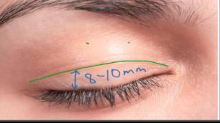 Marking the Upper Eyelid Incision
