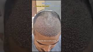 front hair transplant. how to regrow hairs back. short hairtransplant hairloss prp shorts