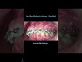 Deep Bite Treatment Explained | Anterior Bite Ramps by Dr.Ajay Kubavat Sure Align Orthodontix n Dent