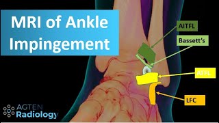 MRI of anterolateral ankle impingement