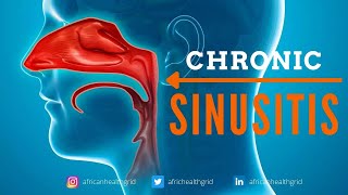Chronic Sinusitis: What is Chronic Sinusitis? Prevention and Treatment