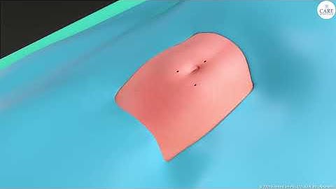 How is Total Hysterectomy done? - The Ultimate Guide | CARE Hospitals