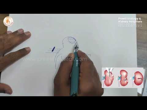 Robotic Partial Nephrectomy: A Minimally Invasive Approach by Dr. V Chandra Mohan