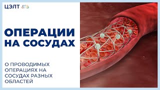 Операции на сосудах. О проводимых операциях на сосудах разных областей(Проблемы с сосудами? Нужна операция? http://www.celt.ru/depart/cardio/operacii/ Отделение сердечно-сосудистой хирургии Многоп..., 2016-09-15T21:09:35.000Z)