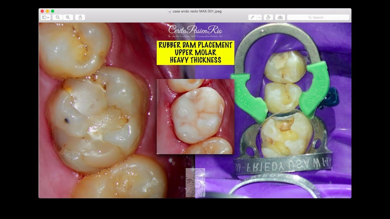 rubber dam placement maxillary molar multiple teeth isolation w14a hu