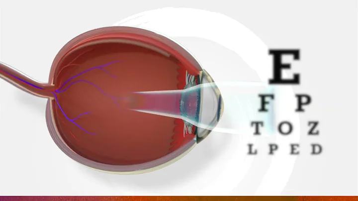 What is myopia? | 3D animation of myopia - DayDayNews