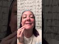 Day 5 Healing After Facial Injections