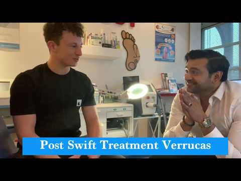 Verruca Swift Microwave Treatment Successful - Abid Hussain Podiatrist