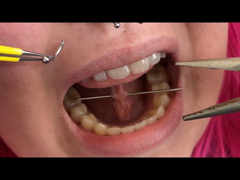 Video: Ein Lorum-Piercing bekommen – wikiHow