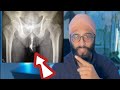 10 more weird things inside people  doctor explains foreignbody funnydoctor embarrassing