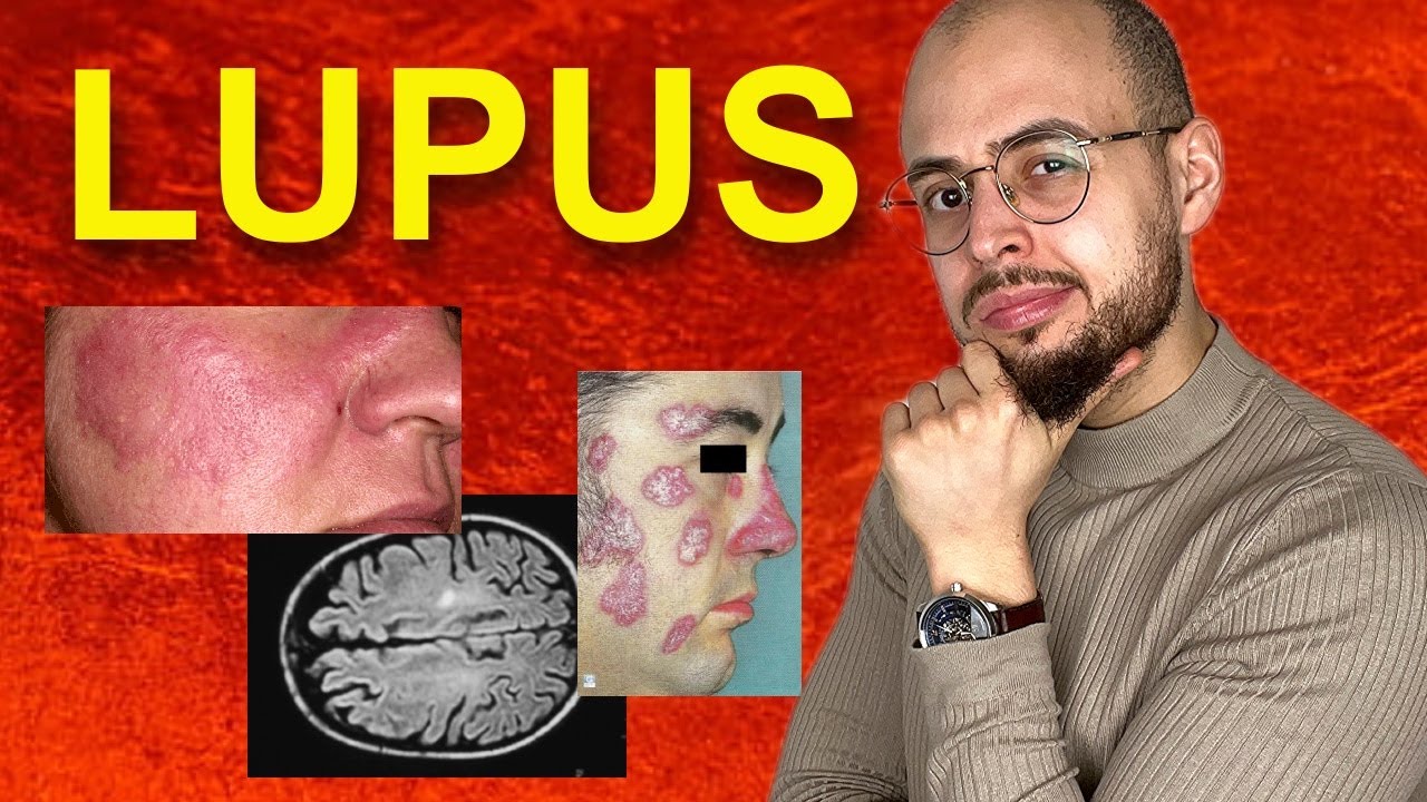 Quels sont les symptômes du LUPUS ?