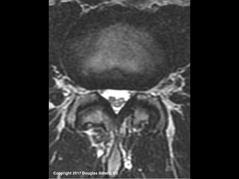 Adhesive Arachnoiditis: An Advanced Lecture