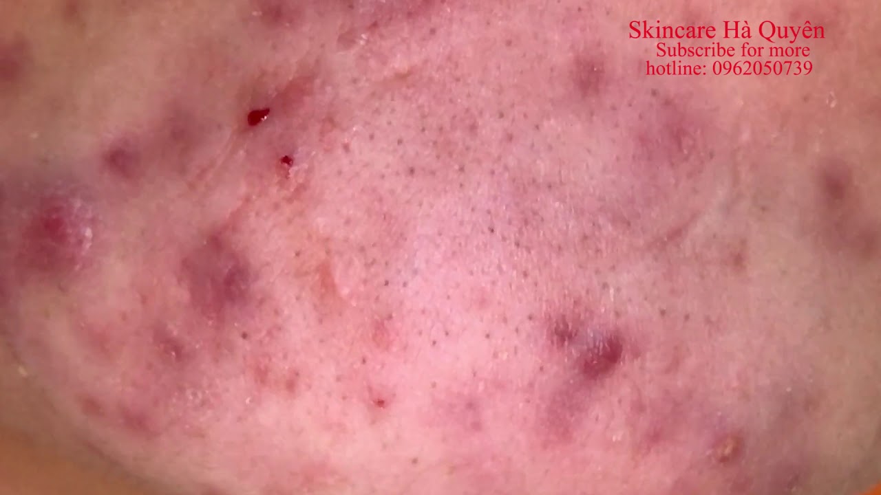 Blackheads and Acne treatment in Ha Quyen Spa on 07/02/2020 - Điều trị mụn tại Hà Quyên spa