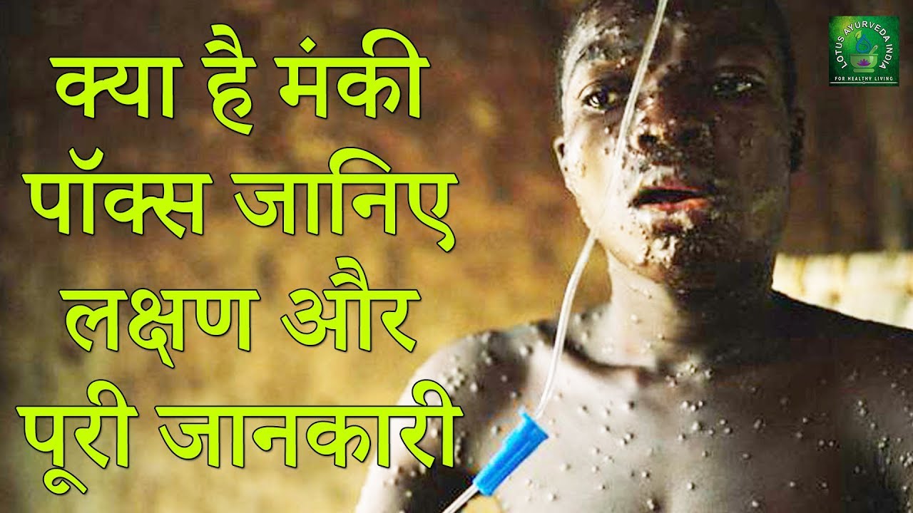 Killer Monkeypox Outbreak || Monkeypox virus || Silent Killers || Lotus